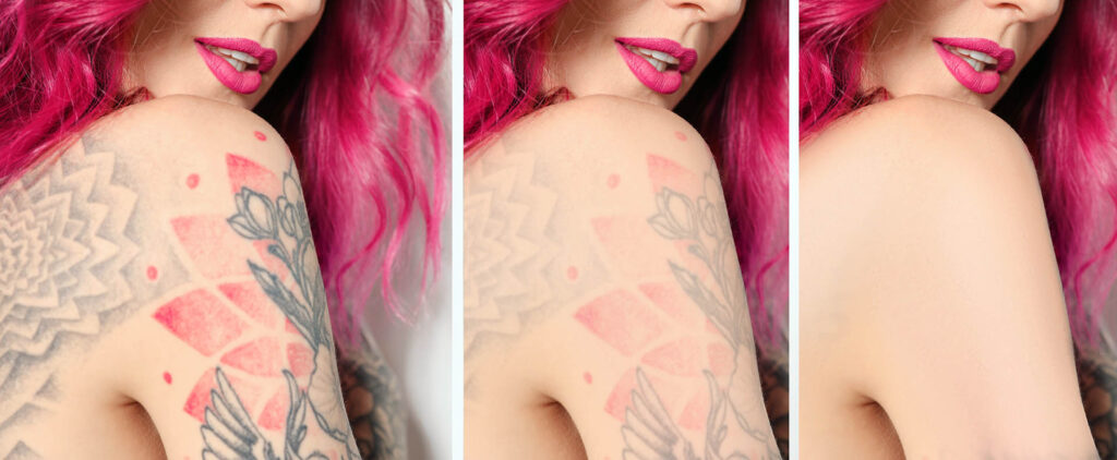 Woman,Before,And,After,Laser,Tattoo,Removal,Procedures,,Closeup.,Collage