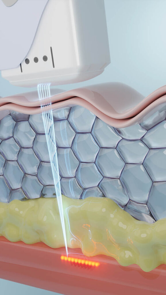 Ulthera,Laser,Treatment,Shot,To,Smas,Skin.,d,Rendering.