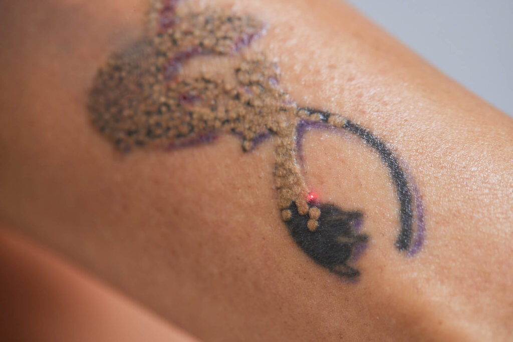 Young,Woman,Undergoing,Laser,Tattoo,Removal,Procedure,In,Salon,,Closeup.